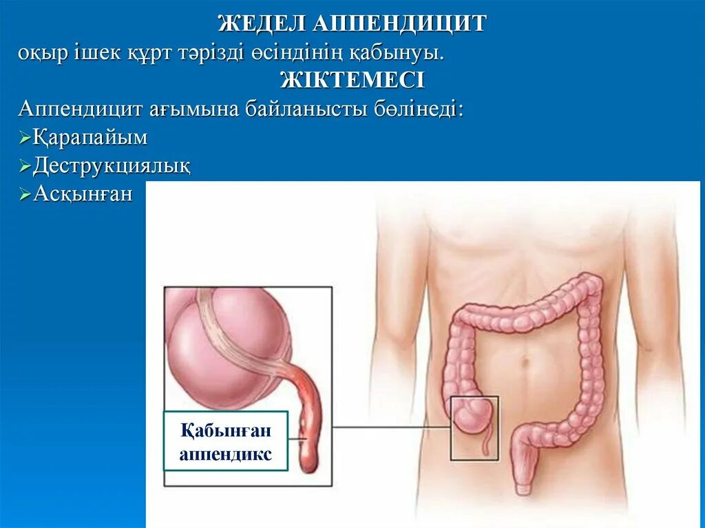 Этапы аппендицита. Воспалённый аппендикс.