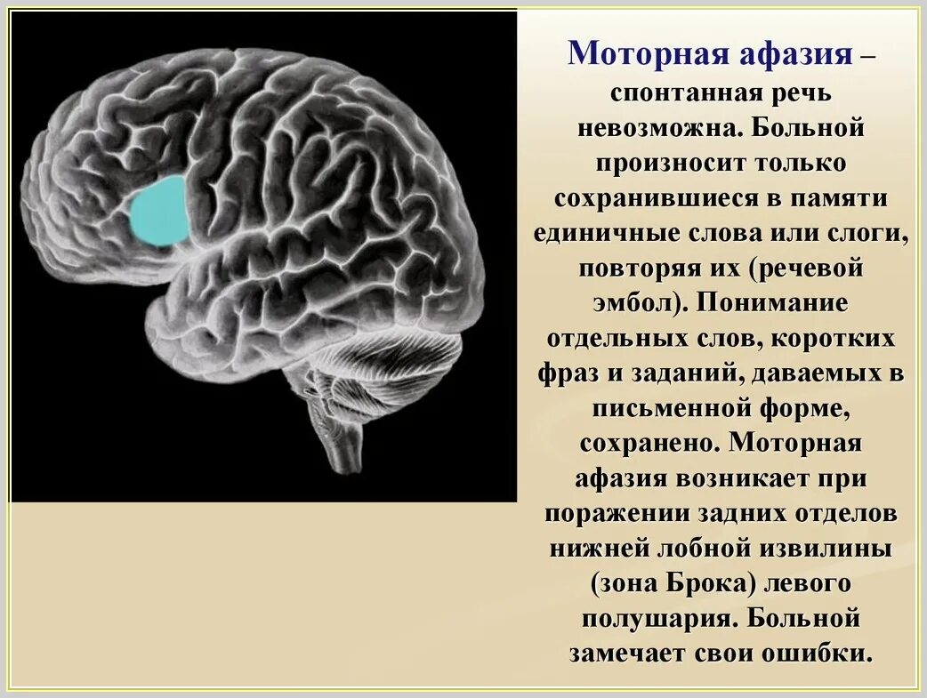 Потеря речи при инсульте. Сенсомоторная афазия. Моторная и сенсорная афазия. Моторная афазия при инсульте. Расстройства речи при инсульте.