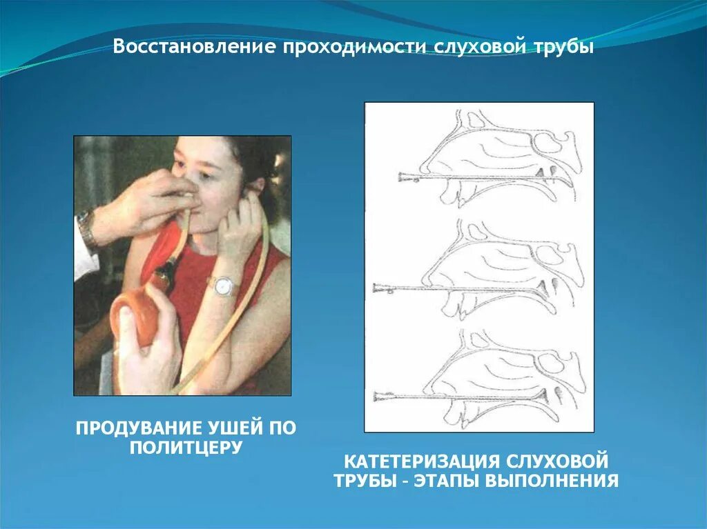 Пароход лор. Продувание слуховых труб по методу Политцера. Катетеризация слуховой трубы. Продувание ушей Политцеру. Исследование проводимости слуховой трубы.