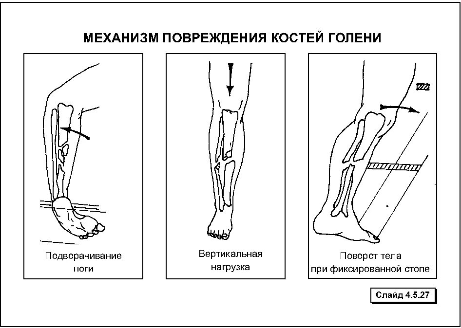 Разрыв кости. Механизм перелома костей голени. Прямой и непрямой механизм перелома. Перелом костей голени механизм повреждения. Непрямой механизм перелома голени.