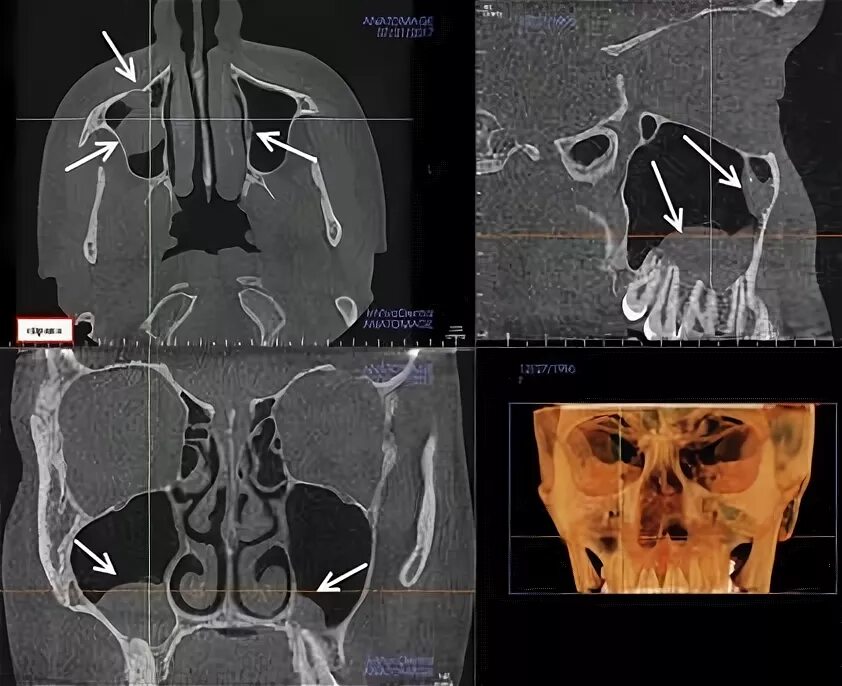 Соустье верхнечелюстной пазухи на кт. Мицетома гайморовой пазухи на кт. Мицетома на кт пазух носа.