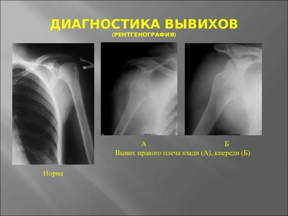 Как выглядит подвывих. Подвывих вывих плечевого сустава рентген. задний подвывих плечевого сустава рентген. передний подвывих плечевого сустава рентген. подвывих плечевого сустава рентген.