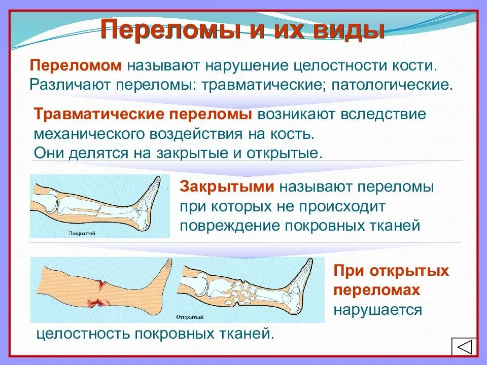 Переломы костей закрытый открытый. Разрушение мягких тканей костей это. Разрушение мягких тканей костей это. Рентгенологические синдромы костно-суставной патологии. Разрушение мягких тканей кости.