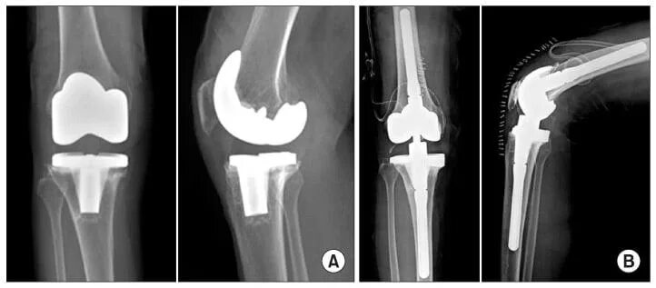 Тотальное эндопротезирование коленного сустава рентген. Тотальный эндопротез коленного сустава рентген. Рентген снимок коленного сустава после эндопротезирования. Тотальное эндопротезирование коленного сустава DEPUY.