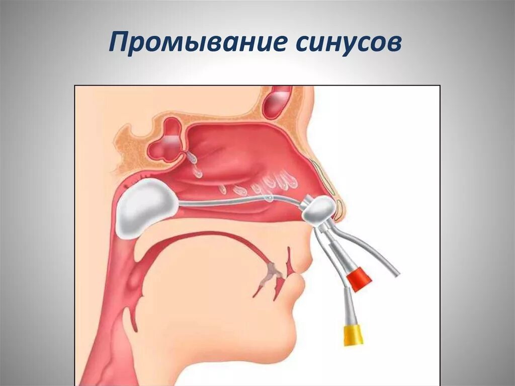 Промывание гайморовых пазух. Пункция околоносовых синусов;. Промывание гайморовых пазух Кукушка. Строение гайморовых пазух промывание.