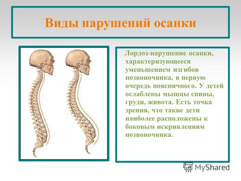 Изгибы позвоночника у детей