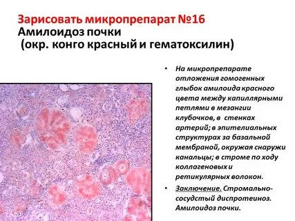 Почечный амилоидоз