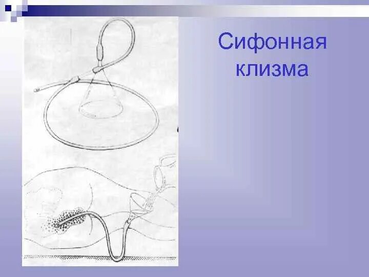 Сифонная клизма кратность. Сифонная клизма. сифонная клизма оснащение. трубка для сифонной клизмы. сифонная клизма алгоритм.