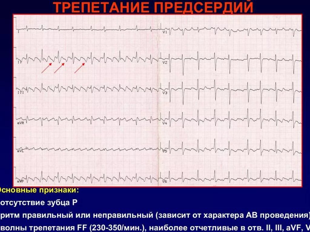 Трепетание предсердий ритм