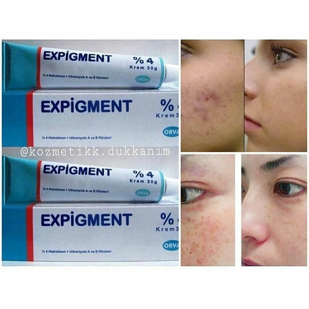 Крем expigment купить. Гидрохинон expigment. Expigment МАЗ. Expigment 4% крем. Турецкий отбеливающий крем expigment.