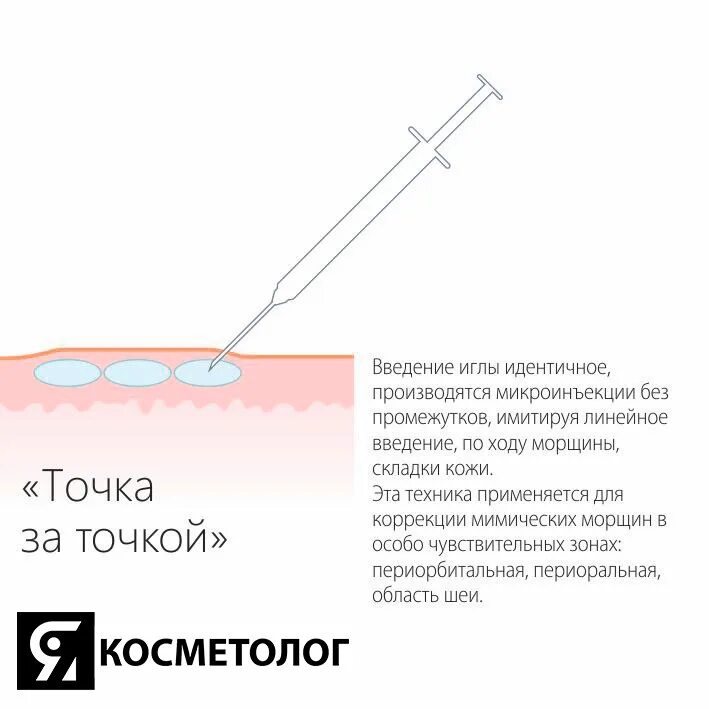 Линейно-ретроградная техника введения филлеров. Ретроградная техника введения филлера. Интрадермальное Введение. Введение иглы.