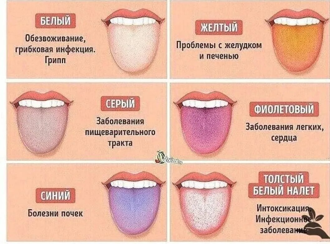 Кислотность языка. Заболевания по цвету языка. Цвет языка о чем говорит. По цвету языка определить болезни.