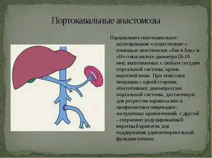 Синдром шунтирования печени