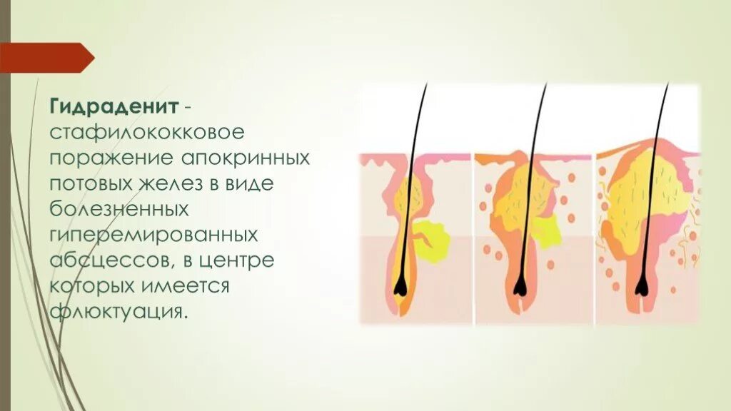 Апокриновые потовые железы гидраденит. Суппуративный гидраденит. Гидраденит- воспаление потовых желез. Гнойное воспаление апокриновых потовых желез. Запах железа носу железы