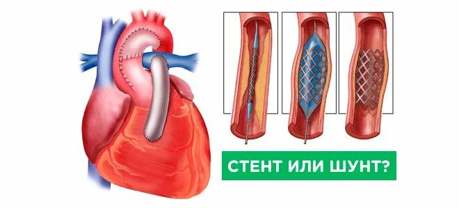 Аортокоронарное шунтирование операция. Шунтирование сосудов сердца стент. Что такое шунтирование сосудов сердца и стентирование. Стентирование и аортокоронарное шунтирование.