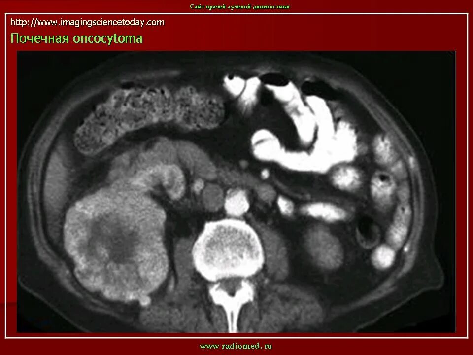 Опухоль почки эзотерика. Рак почки код