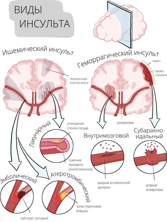 Виды инсульта. Типы ишемического инсульта. Геморрагический инсульт.