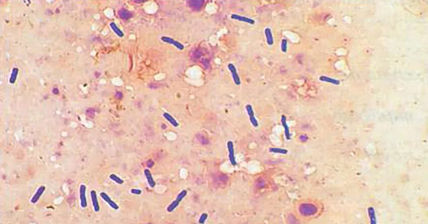 Злокачественный отек возбудитель. Clostridium perfringens возбудитель. Презентация патогенные анаэробы. Клостридии перфрингенс газовая гангрена. Эмфизематозная форма газовой гангрены.