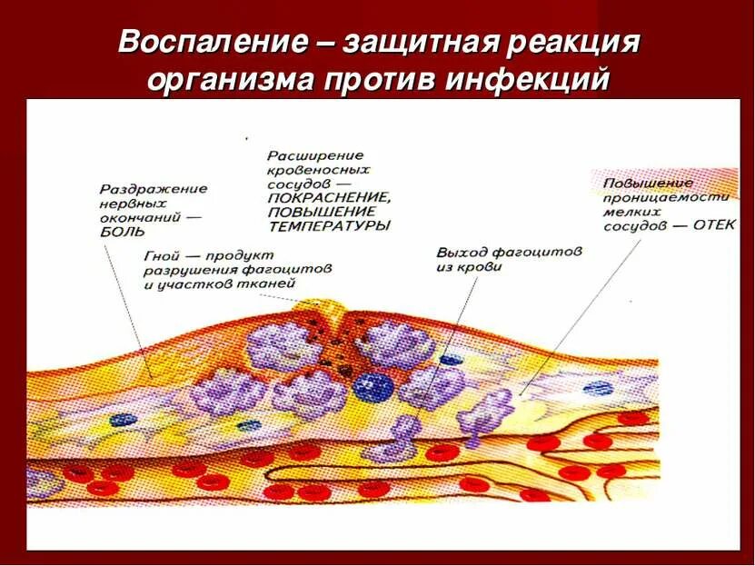 Реакция сосудов. Схема воспалительного процесса. воспалительная реакция и воспалительный процесс. воспалительный процесс рисунок. нейровоспалительный процесс.