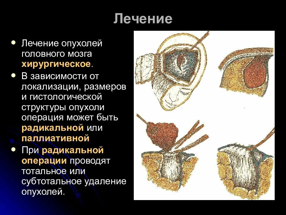 Отек мозга терапия. Новообразование в головном мозге. Опухоль головного мозга лечится. Опухоли головного мозга презентация.