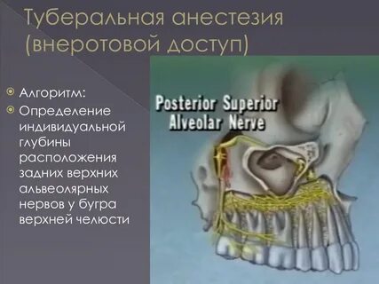Обезболивание верхней челюсти