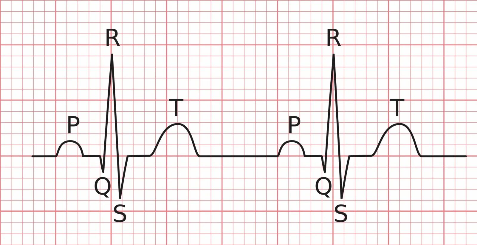 Амплитуда qrs. Комплекс pqrst. инверсия qrs. комплекс qrs в виде буквы м. длины qrs для детей.