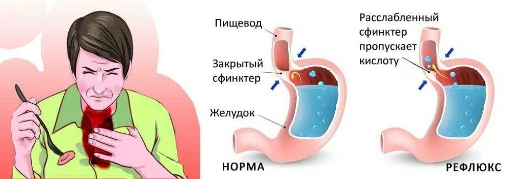 Изжога симптомы и лечение у взрослых