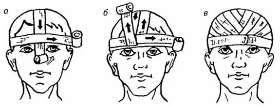Повязка гиппократа техника наложения. Схема наложения повязки шапка Гиппократа. Перевязка шапочка Гиппократа. Повязка шапка Гиппократа техника наложения. Чепец Гиппократа повязка.