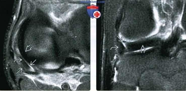 Синовиома коленного сустава мрт. Изменения медиального мениска 1 степени
