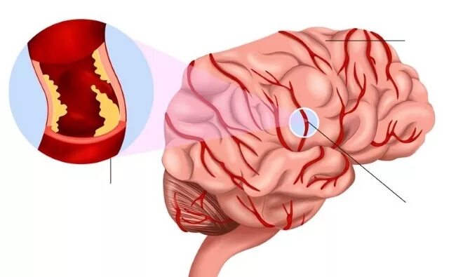 Закупорка головных сосудов. Поражение сосудов головного мозга. Тромбоз сосудов головного мозга. Лопание сосудов головного мозга.