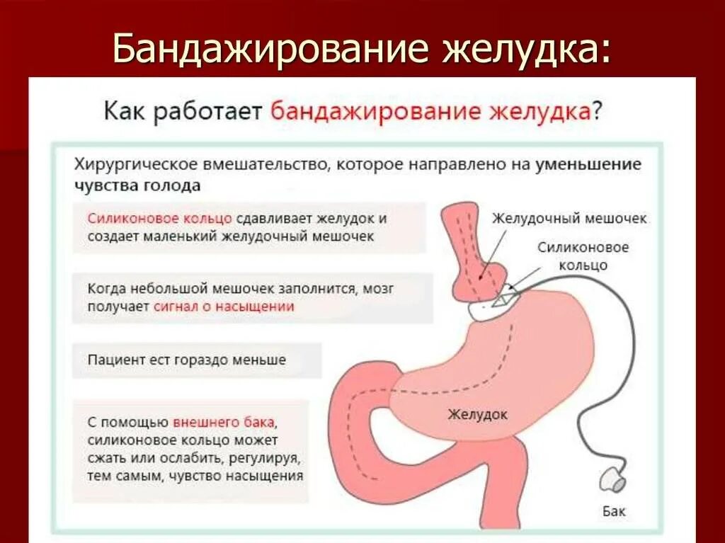 Бандажирование желудка. Как уменьшить желудок без операции