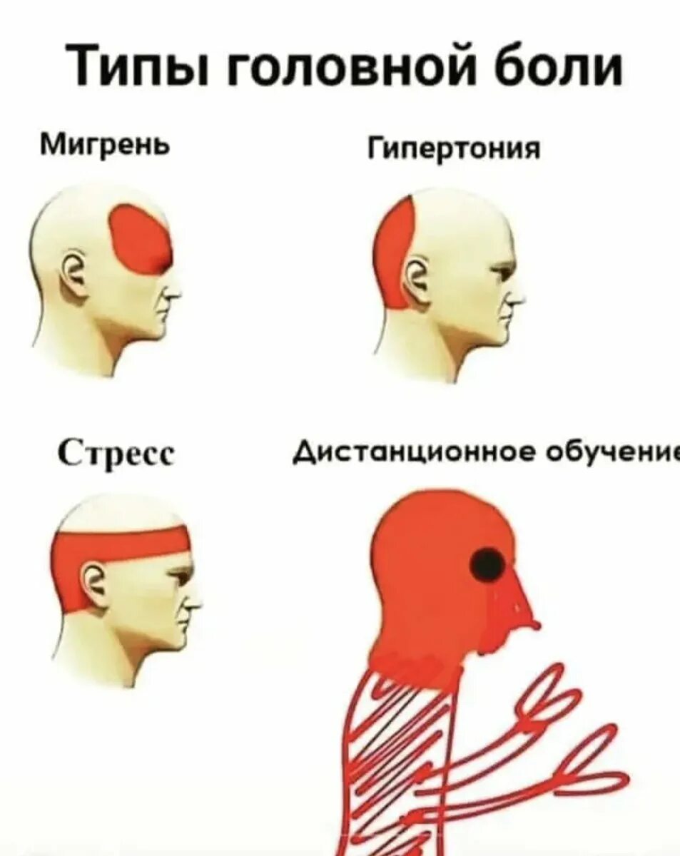 Болит голова народное. Вилюды, головной боли. Боль в голове. Головная боль типы боли. Виды головной боли и причины.