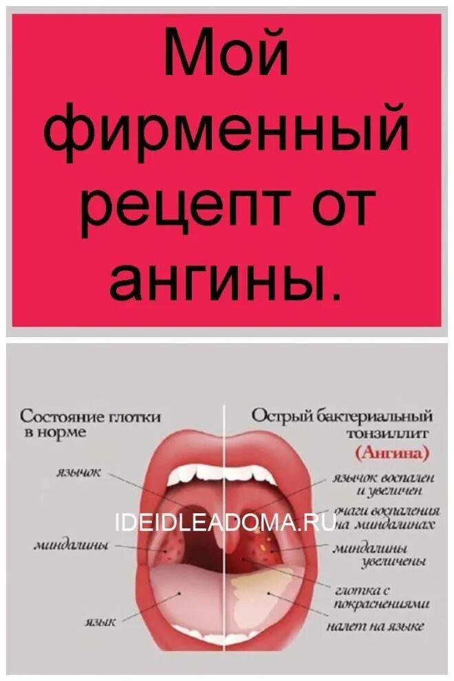 Народные средства от ангины взрослым. Свекольный сок от горла. Ангина лечение быстро домашними. Как быстро и чем вылечить ангину. Ангину народными средствами.