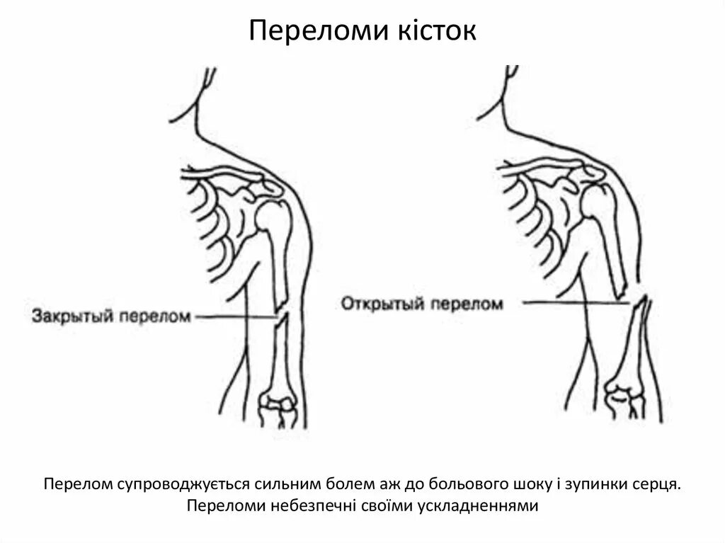 Закрытые и открытые повреждения. Открытый и закрытый перелом. Открытые и закрытые повреждения. Открытый перелом и закрытый перелом.