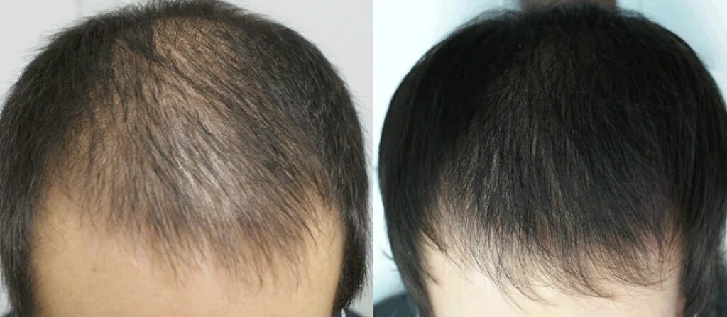 Плазмотерапия для волос до и после мужчины. Мезотерапия волос мужчин. Плазмолифтинг для волос мужчинам.