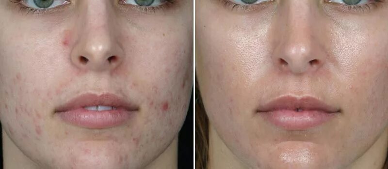 Восстановиться после чистки. Ультразвуковая чистка лица до и после. Чистка лица до и после фото. Ультразвуковая очистка лица до и после. Лицо до и после косметолога.