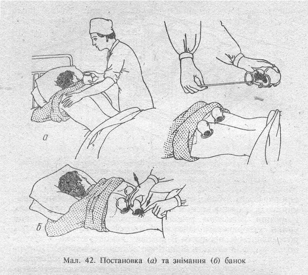 Техника постановки грелки. Куда ставят грелки. Постановка грелки алгоритм. Использование грелки алгоритм. Постановка грелки.