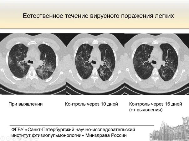 Уплотнения паренхимы по типу матового стекла. Уплотнение по типу матового стекла. легочная ткань по типу матового стекла. поражение легких по типу матового стекла. уплотнения по типу матового стекла в легких что это.