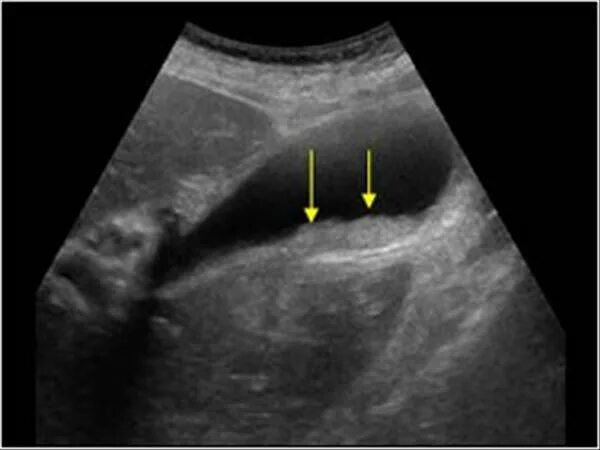 Сгустки в желчном пузыре. Билиарный сладж в желчном пузыре. Билиарный сладж в желчном пузыре на УЗИ. Замазкообразная желчь. Замазкообразная желчь на УЗИ.