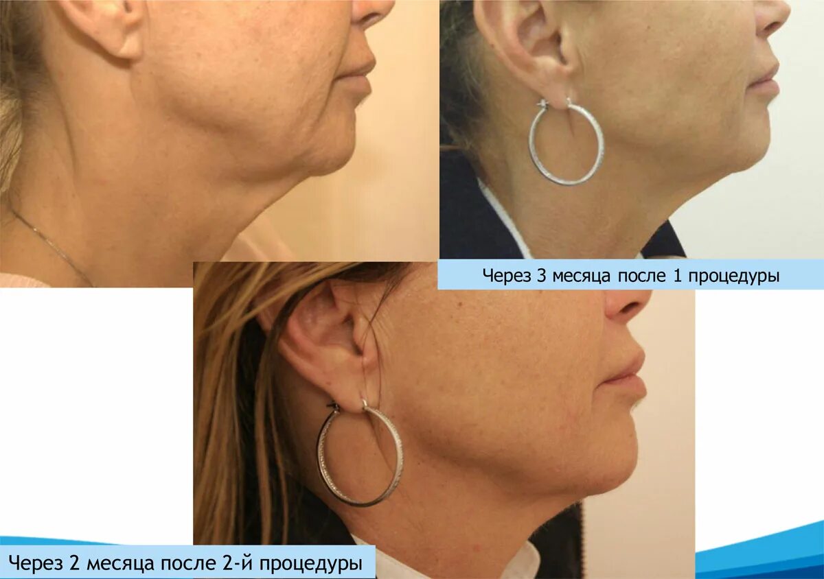 Смас ультраформер. Ультраформер до и после подбородок. Смас ультраформер до и после. Смас лифтинг ультраформер. Ультраформер результаты.