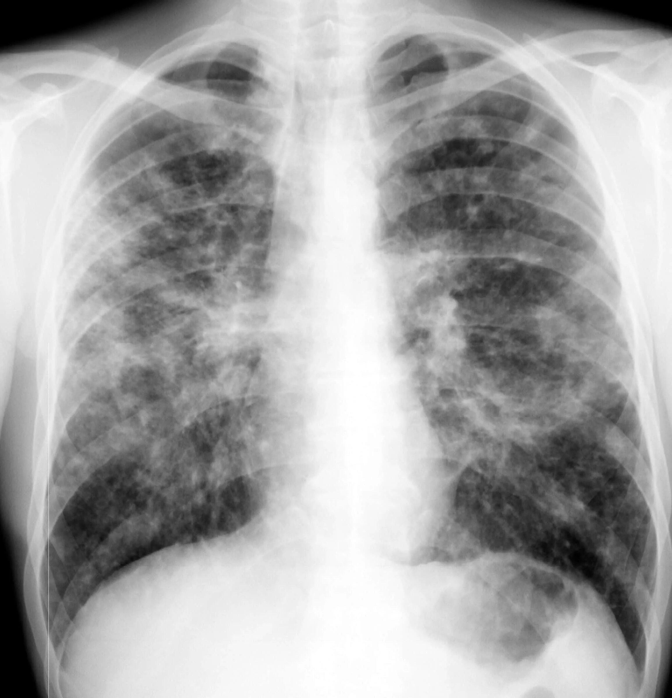 Внутренний туберкулез. Миллиарныйтуберкулез легких рентген. Милиарный туберкулез рентген. Миллиарный туберкулёз рентген.