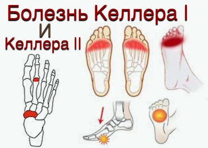 Ладьевидная кость стопы болезнь Келлера. Болезнь Келлера 2 плюсневой кости стопы. Болезнь Келлера 2 степени. Болезнь Келлера 2 кости. Болезнь келлера что это такое