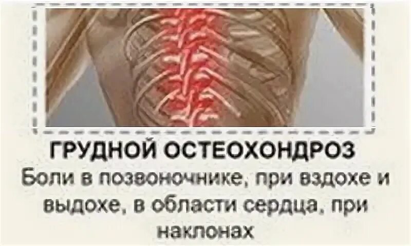 Грудной остеохондроз симптомы ощущение