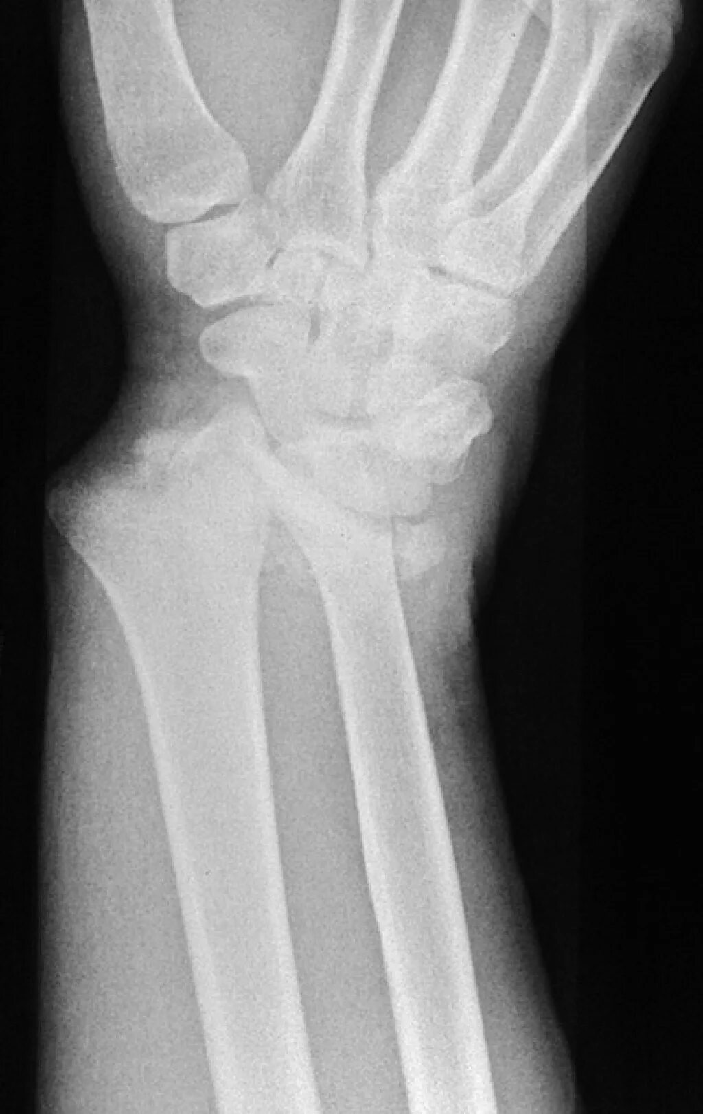 Оскольчатый перелом н\3 лучевой кости. Перелом лучезапястного сустава рентген. Оскольчатый перелом лучевой кости. Перелом лучевой кости рентген.