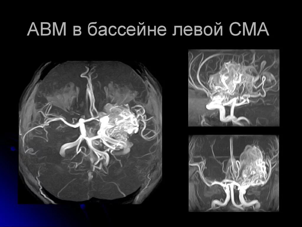 Бассейн левой средней мозговой артерии. Мальформация средней мозговой артерии. Инсульт в бассейне средней мозговой артерии. Сосудистая патология мальформация.