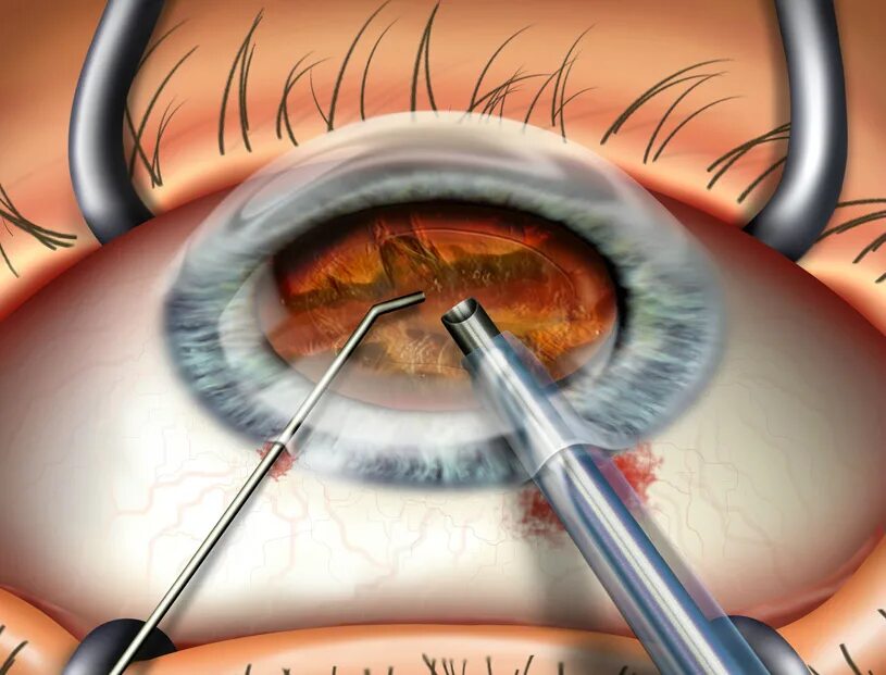 Операция катаракта замена хрусталика отзывы. Факоэмульсификация осложненной катаракты. Ультразвуковая факоэмульсификация. Лазерная рефракционная кератопластика.
