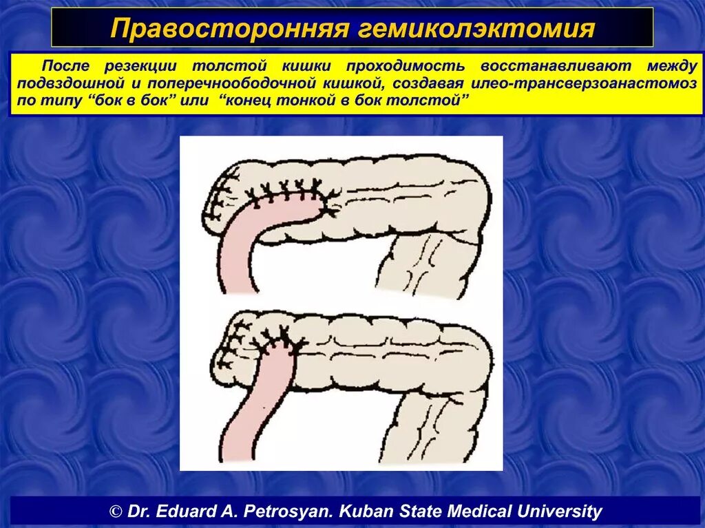 Правосторонняя гемиколэктомия. Операция правосторонняя гемиколэктомия. Гемиколэктомия ободочной кишки. Операция левосторонняя гемиколэктомия. Как восстановить кишечник после операции