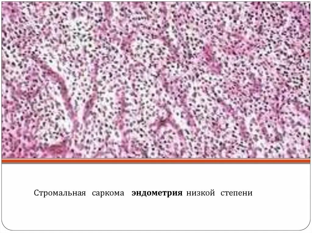 Стромальная саркома