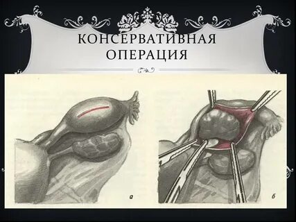 Острый живот операция