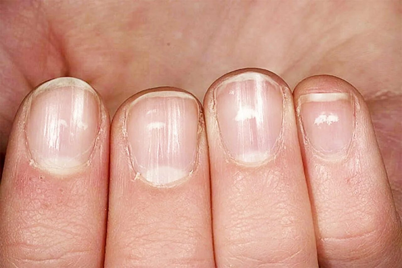 Что означают полосы на ногтях. Ониходистрофия, лейконихия. Микотическая лейконихия. Лейконихия белые пятна на ногтях.